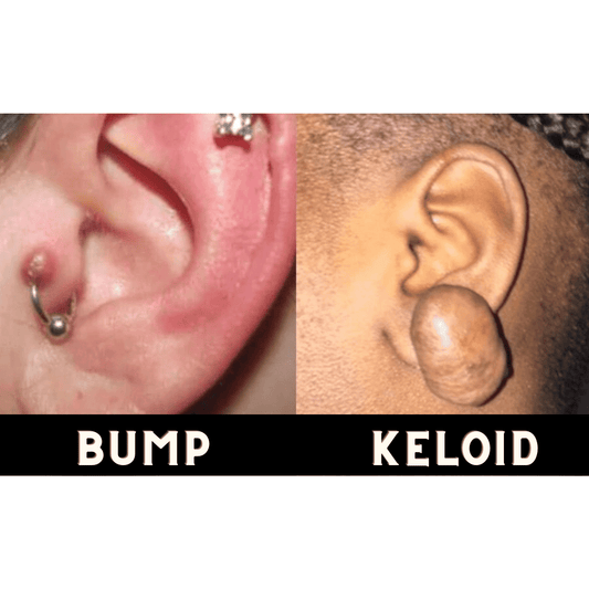 Keloid and bumb