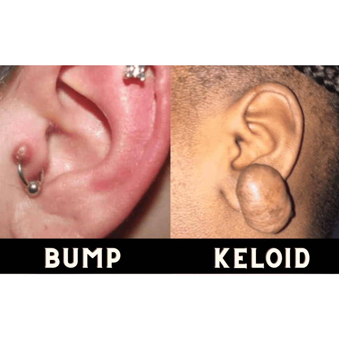 Keloid and bumb